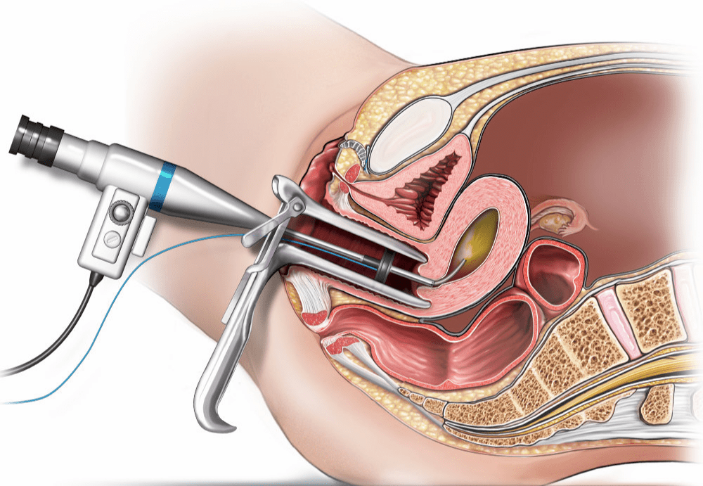 Hysteroscopy at Wish fertility