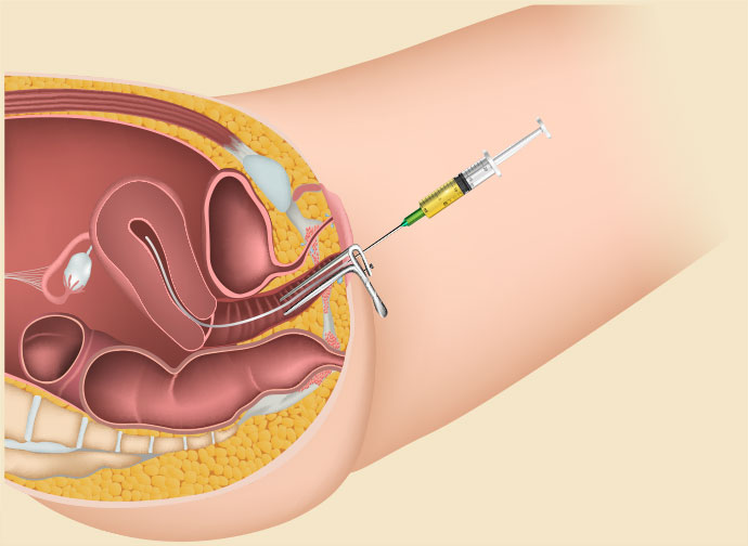 Intrauterine Insemination (IUI)