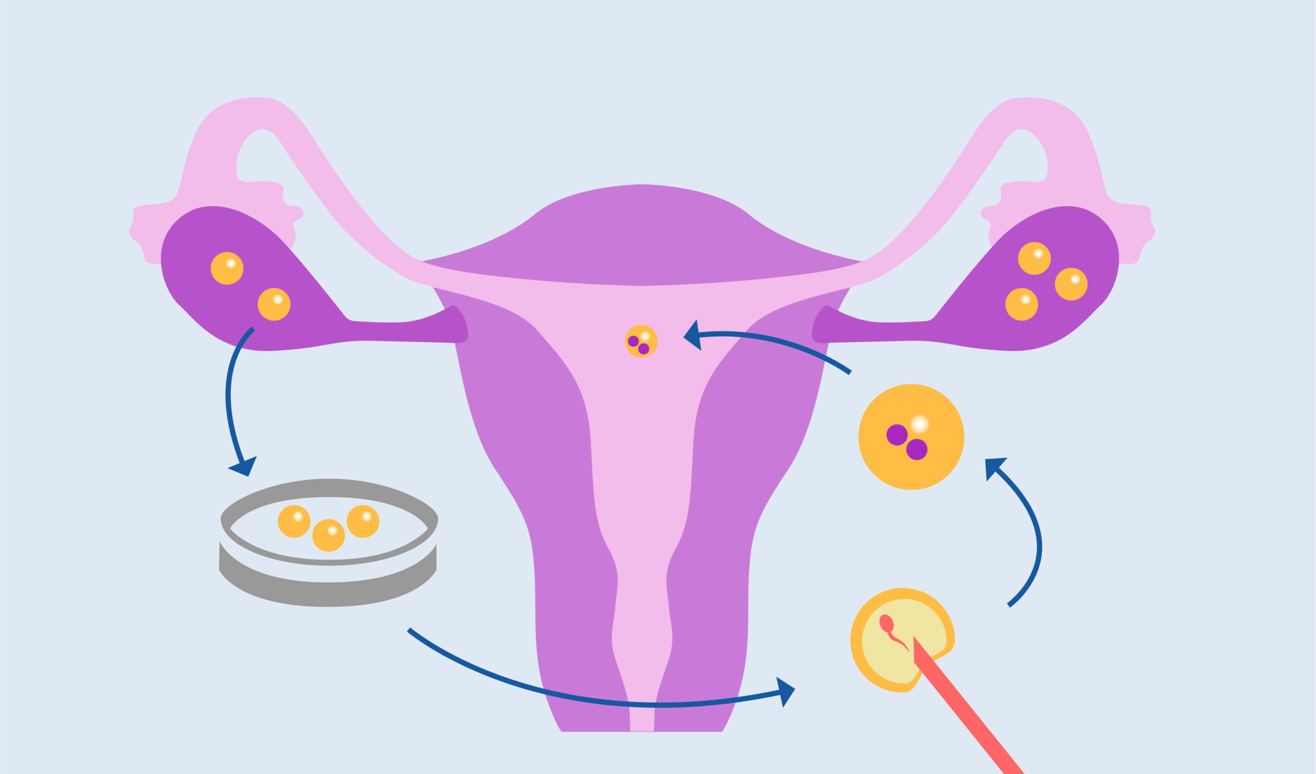 Intracytoplasmic Sperm Injection (ICSI)